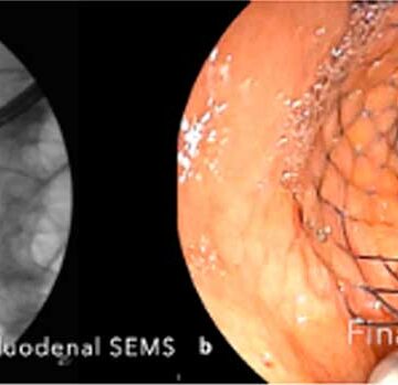 Endosonography-guided rescue procedures after failed ERCP in a patient with pancreatic ductal adenocarcinoma