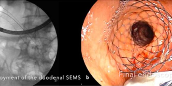 Endosonography-guided rescue procedures after failed ERCP in a patient with pancreatic ductal adenocarcinoma