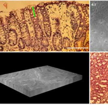 Early stages of colorectal cancer characterization by autofluorescence 3D microscopy: a preliminary study