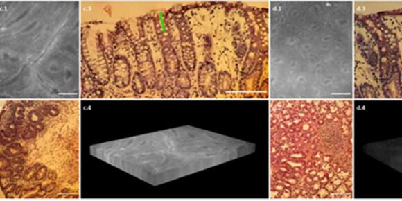 Early stages of colorectal cancer characterization by autofluorescence 3D microscopy: a preliminary study