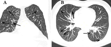 Rate of infection (tuberculosis) in brazilians IBD private patients:  follow-up 15 years